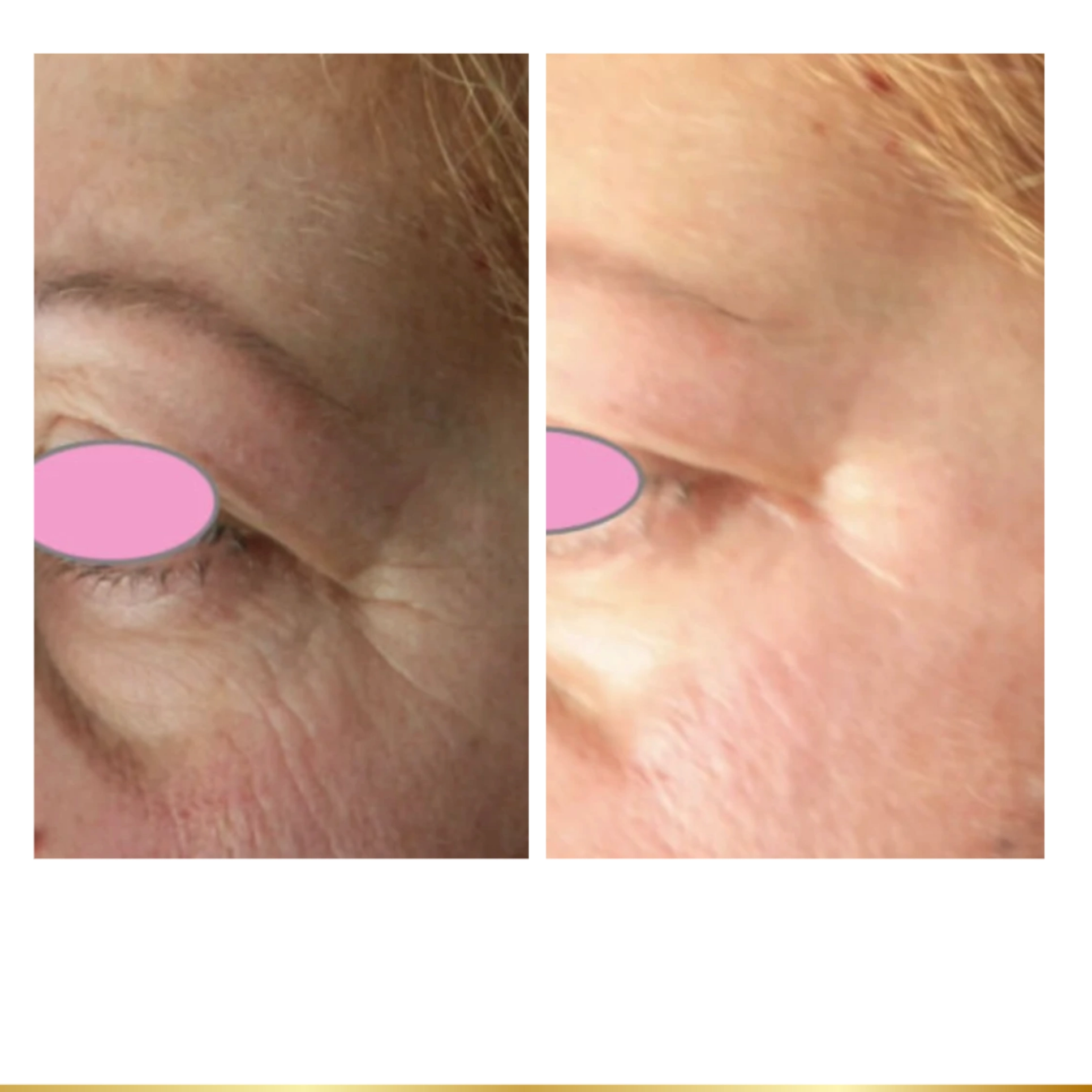 Under-eye area transformation highlighting smoother skin and reduced signs of aging.