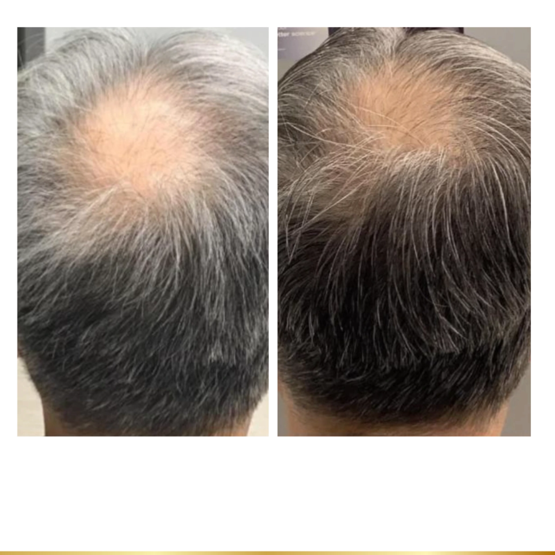 Before and after hair restoration showing reduced bald spot and improved hair density