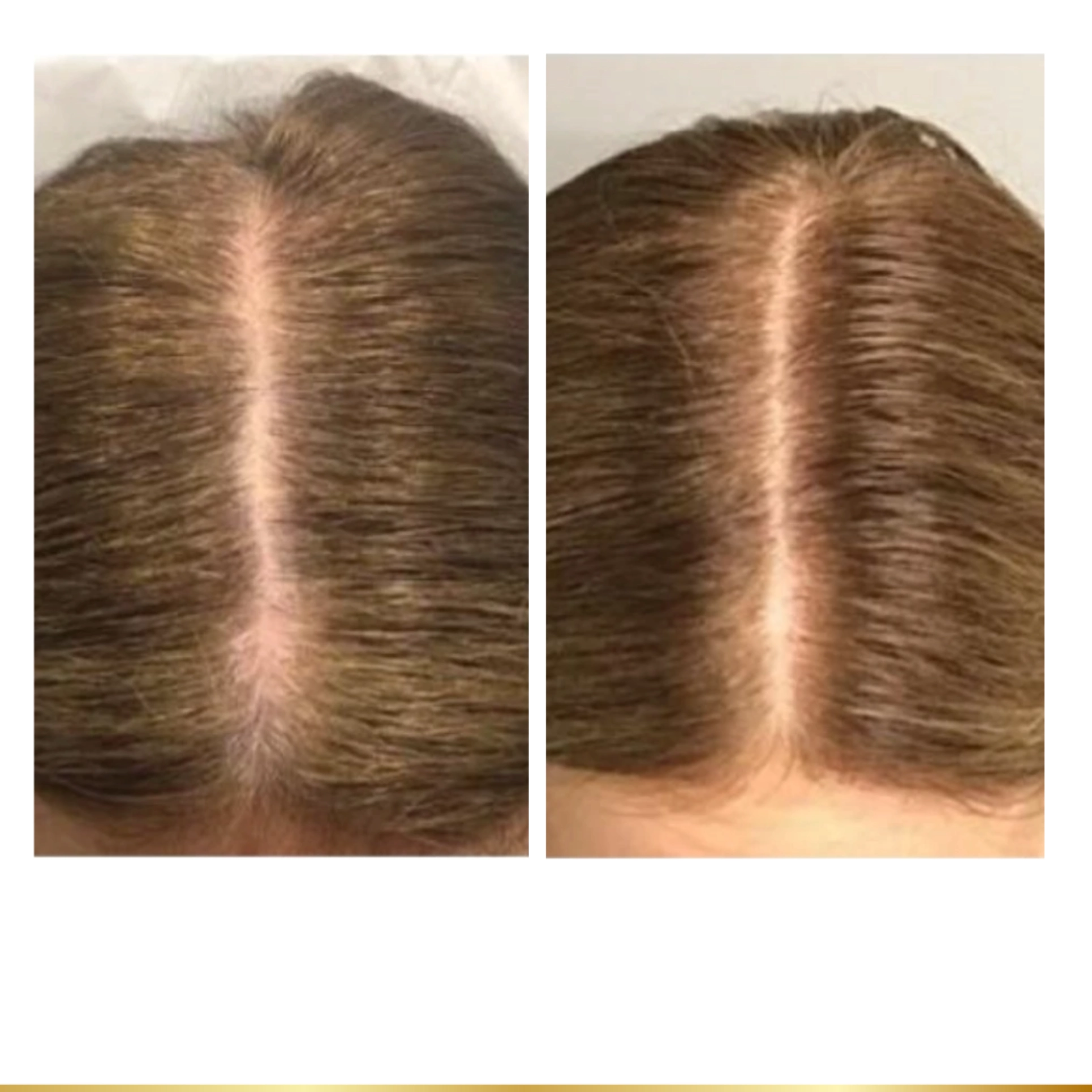 Before and after hair restoration showing improved hair density and reduced visibility of scalp line.