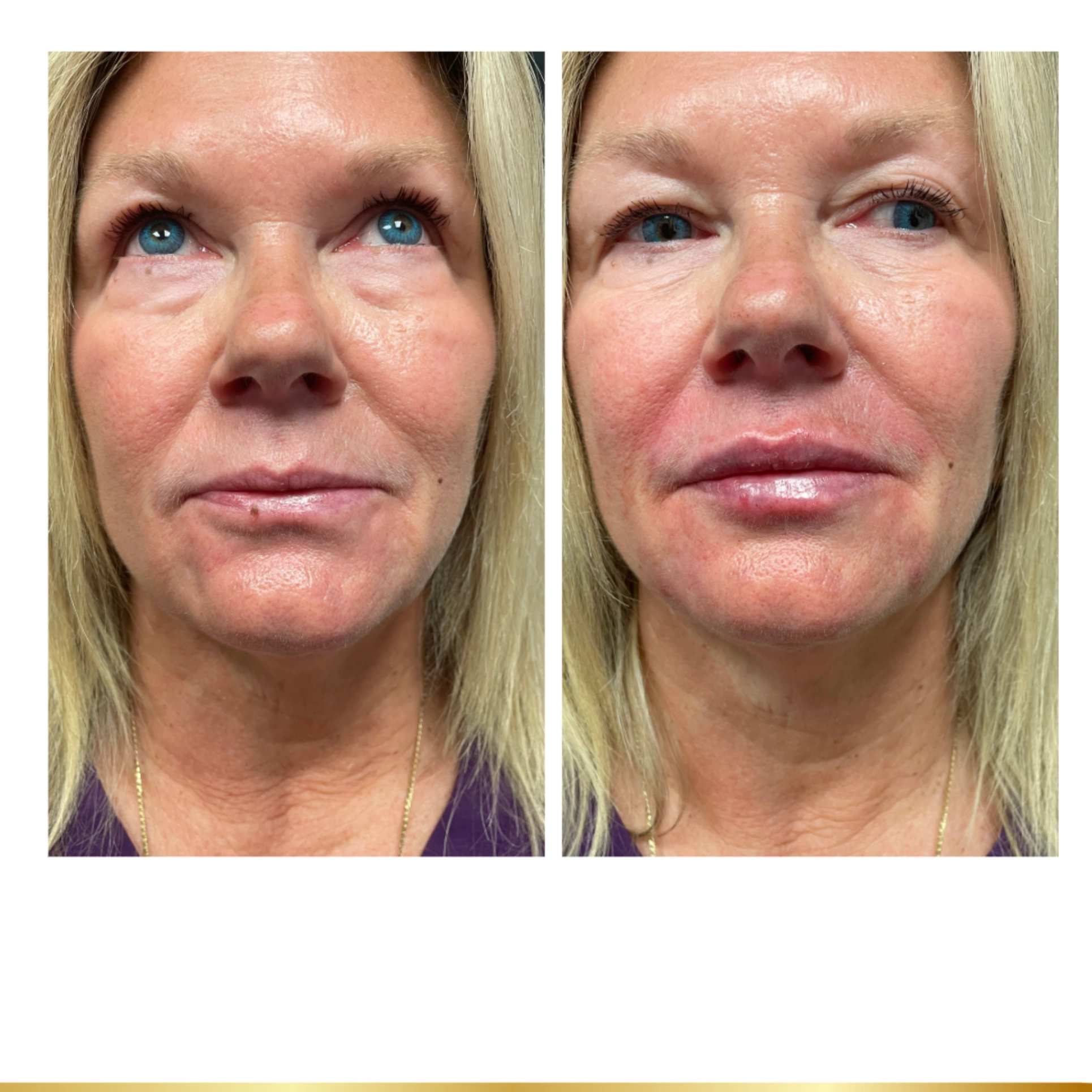 Before and after lip and facial filler treatment on middle-aged woman