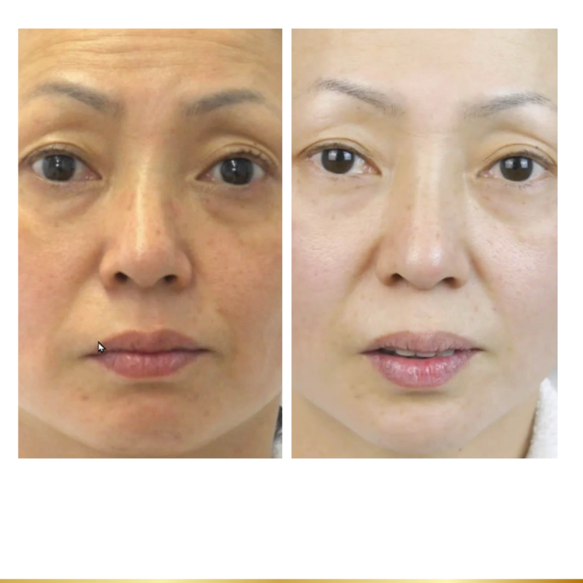 Before and after facial rejuvenation showing smoother skin, reduced lines, and brighter appearance