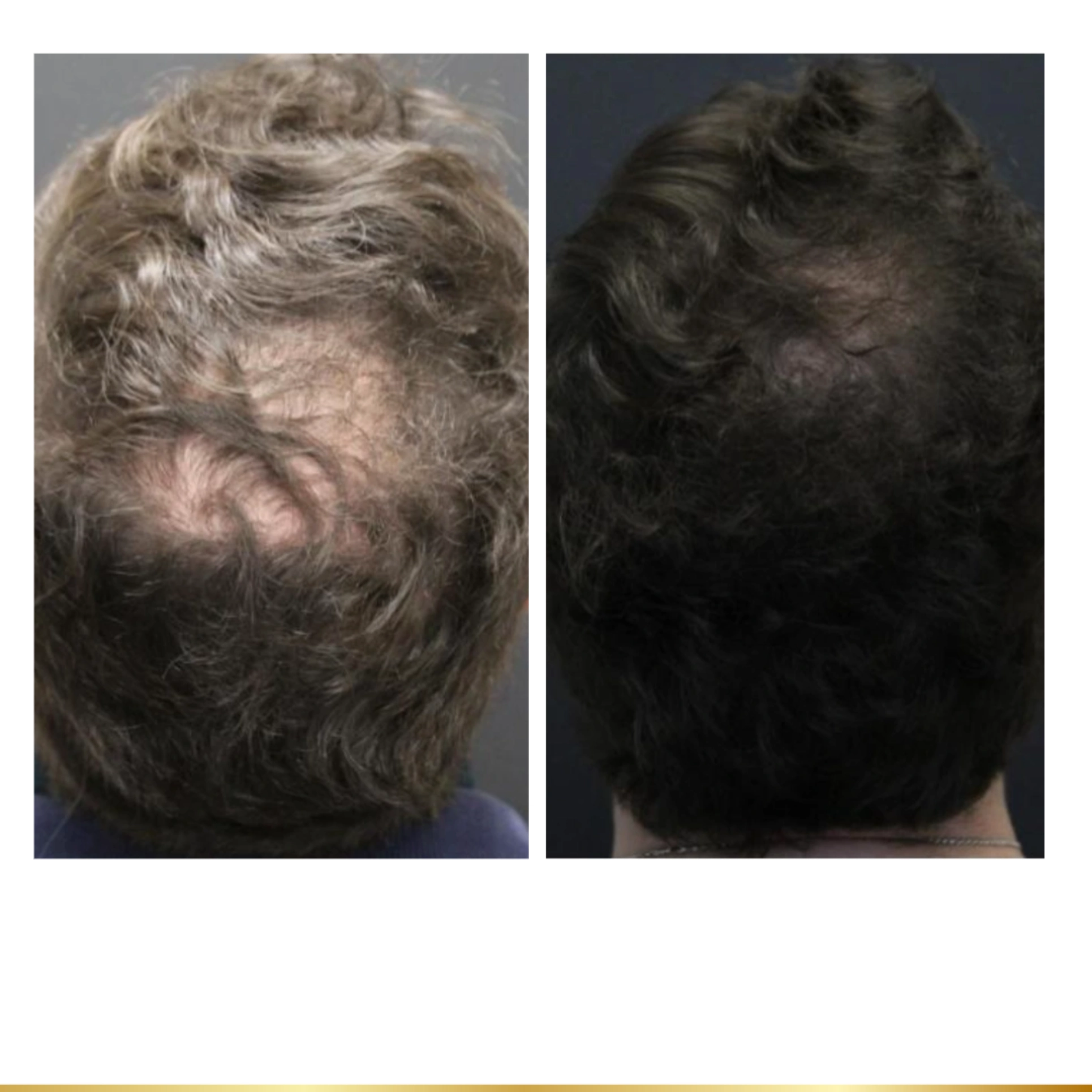 Non-surgical skin tightening results reducing sagging around chin and jawline.